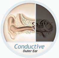 condusctive loss outer ear